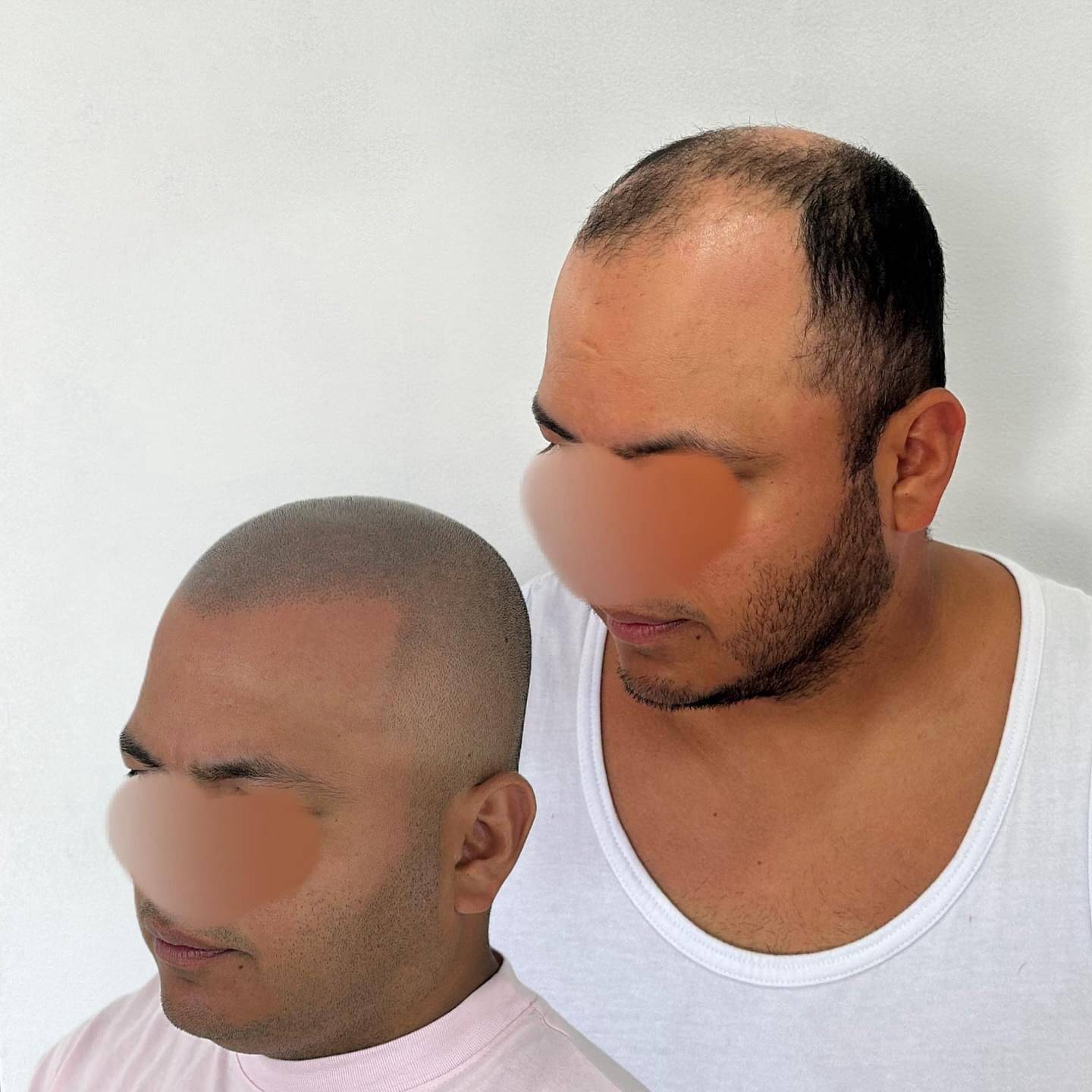 micropigmentación10