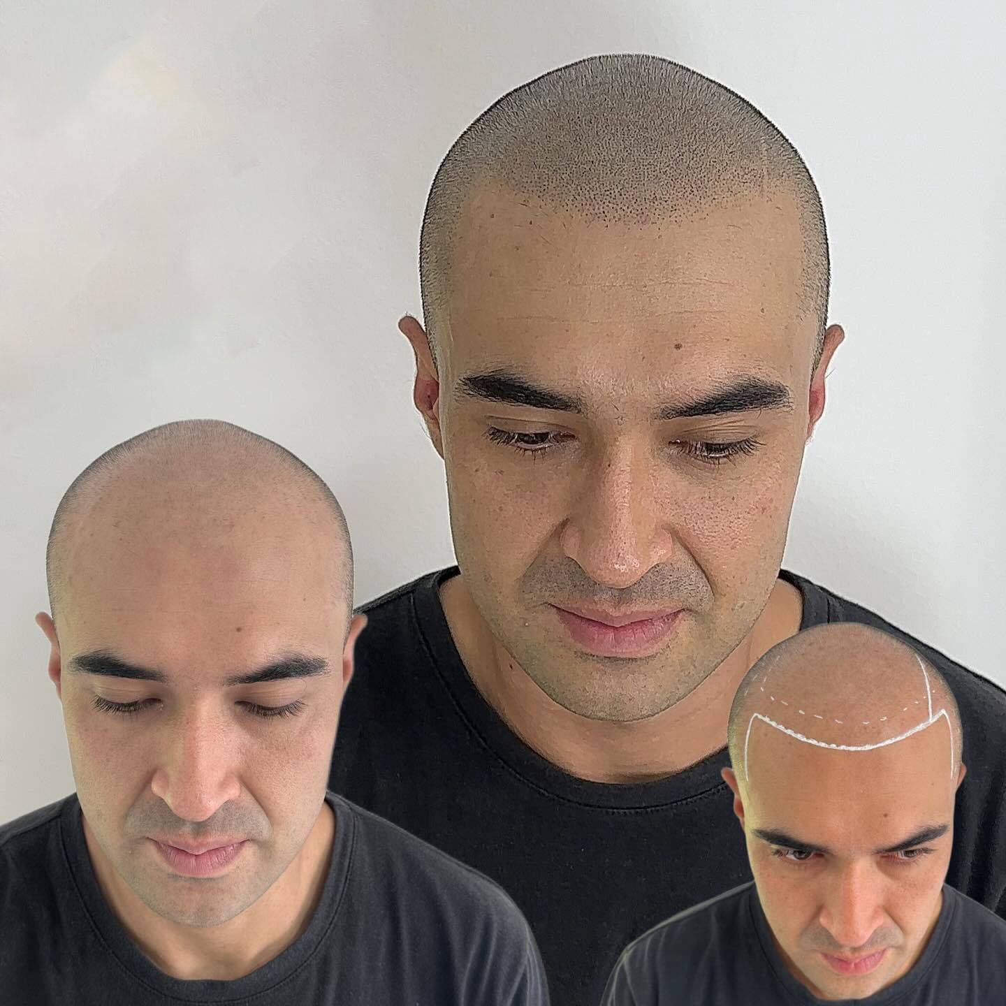 micropigmentación6