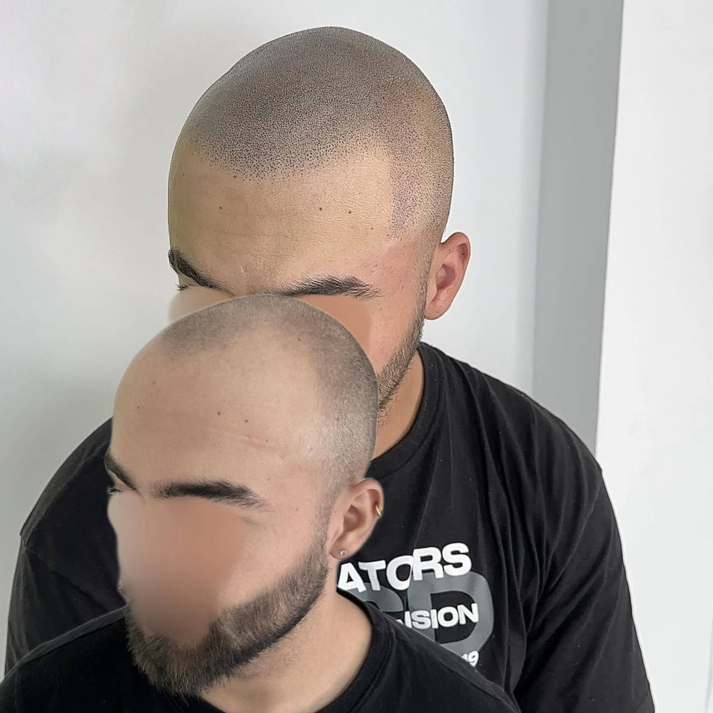 micropigmentación9